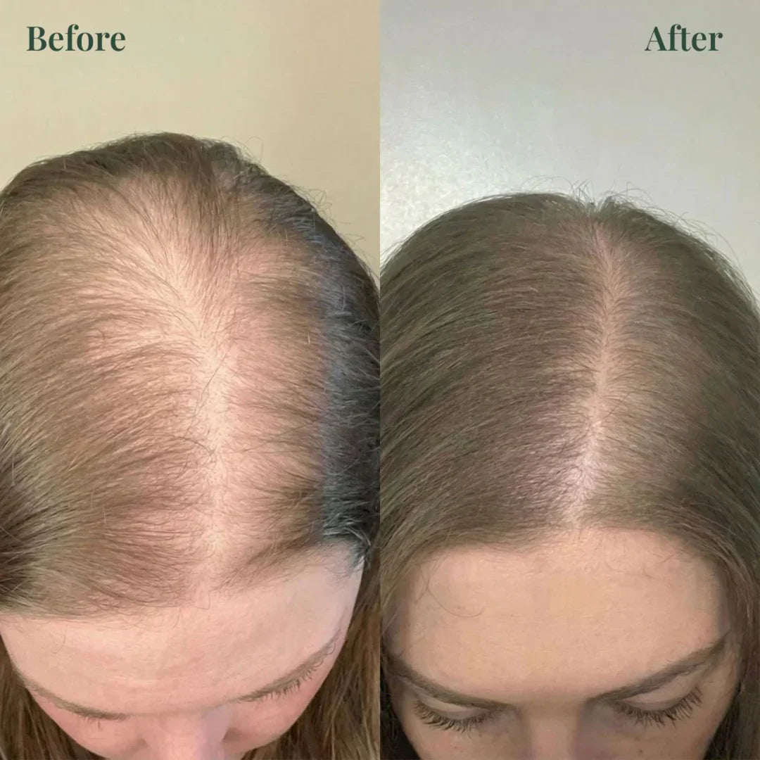 Kerarose Rosemary Shampoo For Hair Growth (Buy 1 Get 1 Free 🔥🔥)